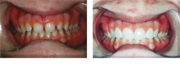 Closed spaces, and turned 'small' teeth into normal sized teeth. 1 visit.