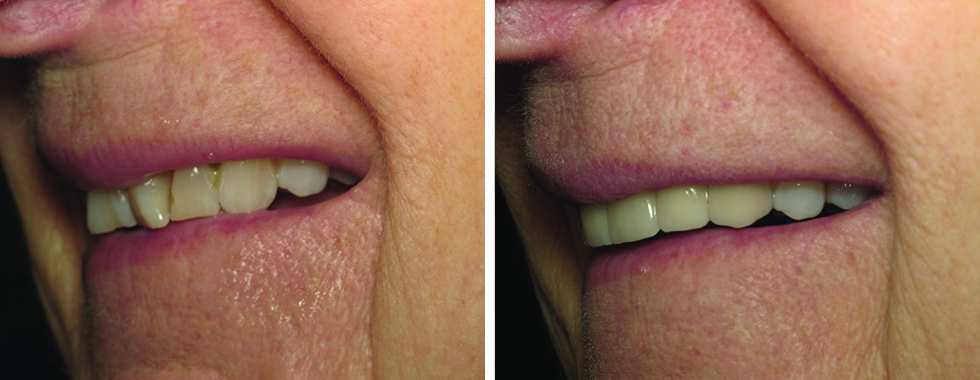 Badly worn and crooked incisors