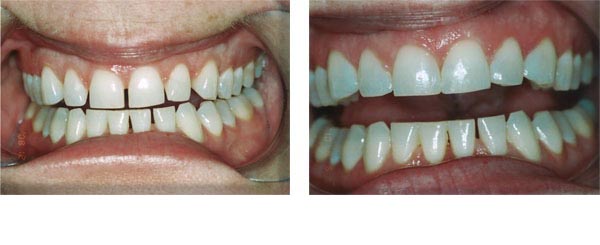 Naturally discolored teeth treated with composite veneers. 1 visit.
