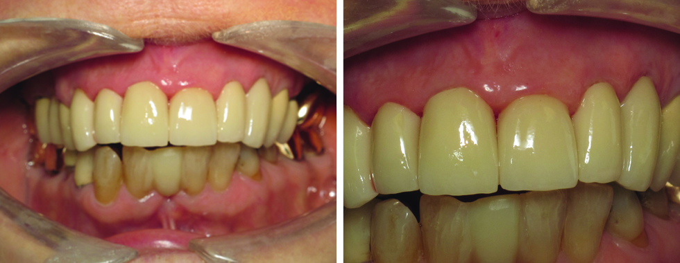 All-porcelain crowns in the mouth