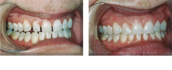 Unsightly spaces closed with composite only (NOT veneers)