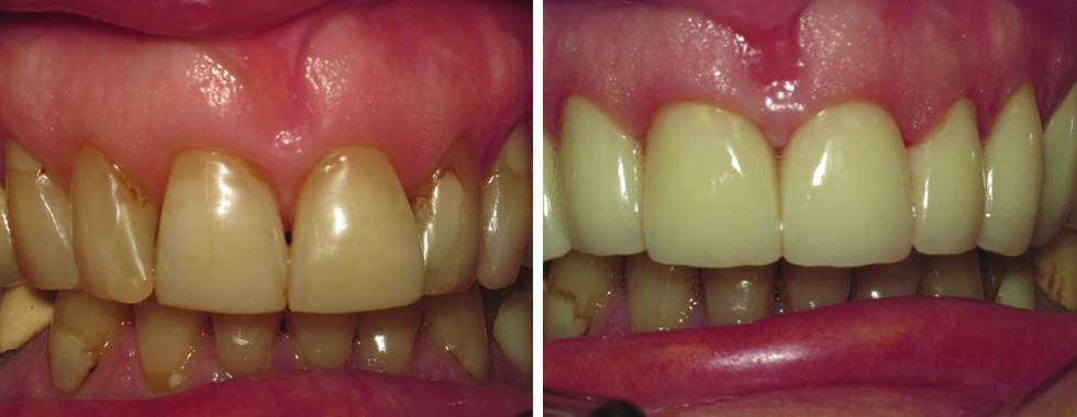 All porcelain crowns to greatly improve esthetics