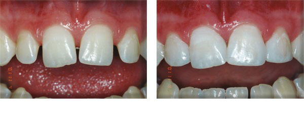 Closing spaces with composite.