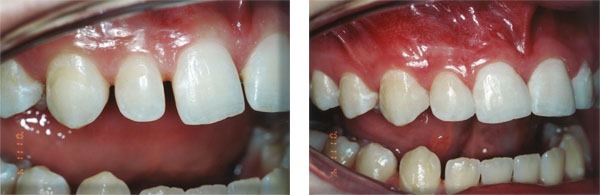 Closing spaces with composite.
