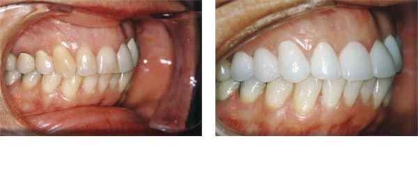 All-porcelain crowns on upper teeth.