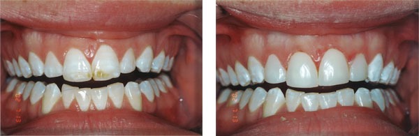 Composite veneers to cover stains.