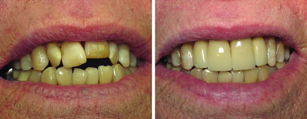 4 all-porcelain crowns to make a drastic esthetic improvement.