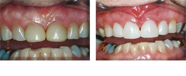 4 composite veneers to replace very old veneers.