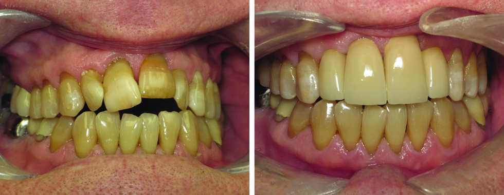 4 all-porcelain crowns to make a drastic esthetic improvement.