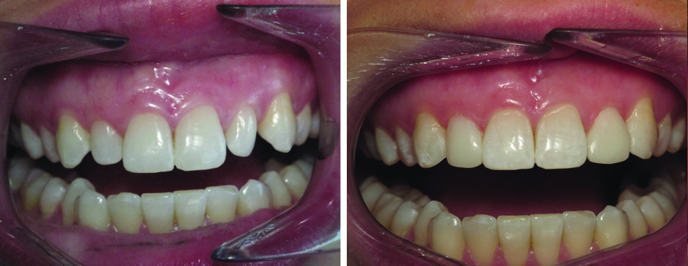 Cosmetic bonding to reshape smaller teeth