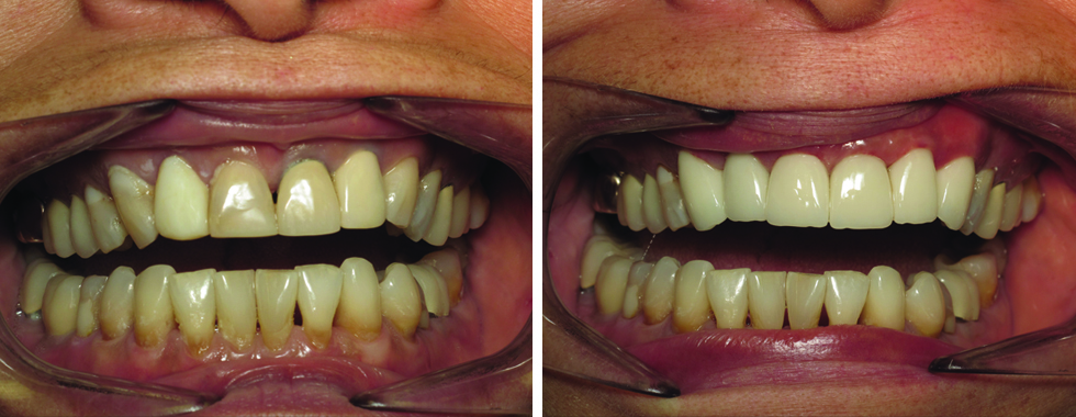 Replacing older, discolored crowns. 67 years old.