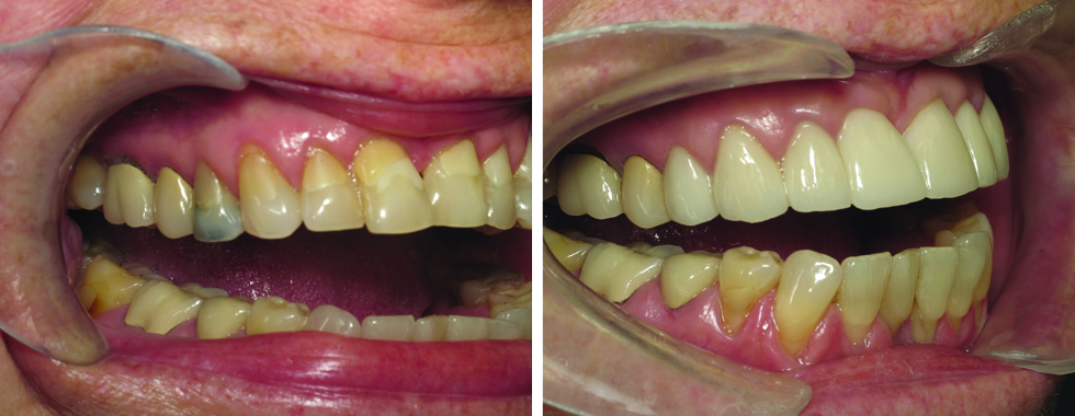 All-porcelain crowns to "straighten" teeth and cover older, larger restorations. "Instant orthodontics".