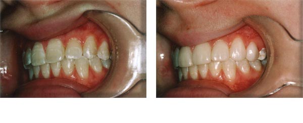 Composite veneers to brighten darker teeth after removal of orthodontic brackets.