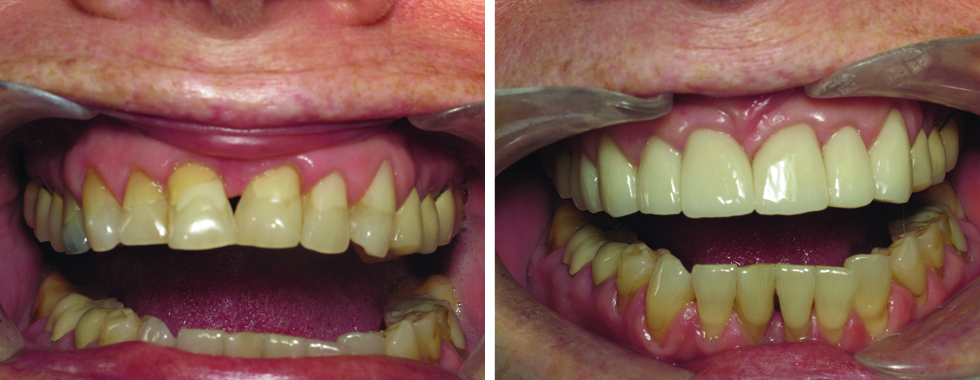 All-porcelain crowns to "straighten" teeth and cover older, larger restorations. "Instant orthodontics".