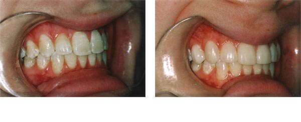 Composite veneers to brighten darker teeth after removal of orthodontic brackets.