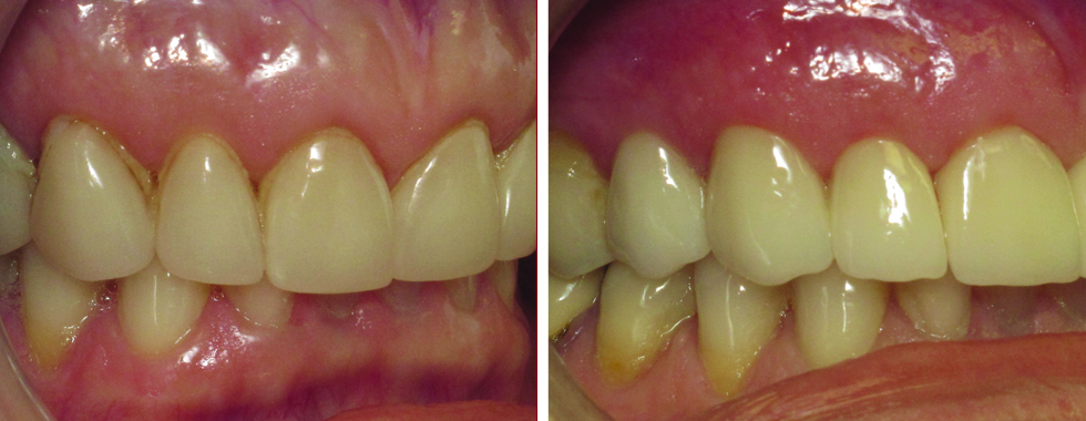 All-porcelain crowns to replace older porcelain veneers.