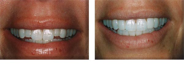 Composite veneers to lengthen the short lateral incisors and make the central incisors not look so 'big'.