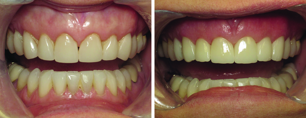 All-porcelain crowns to replace older porcelain veneers.