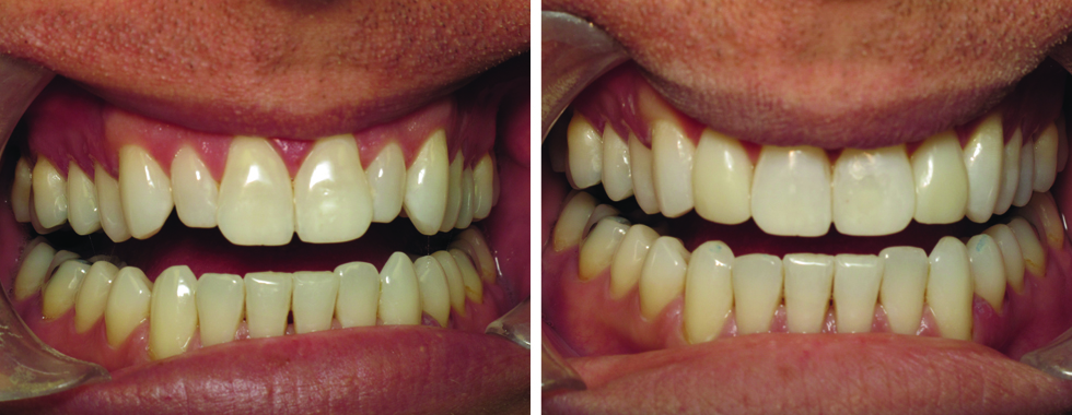 Composite veneers on the 2 lateral incisors to "build them out" and make them even with adjacent teeth. Much quicker and less expensive than orthodontics!