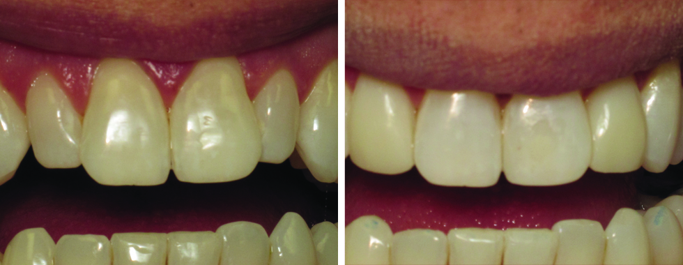 Closing spaces of lateral incisors with composite. No "novocaine" necessary.
