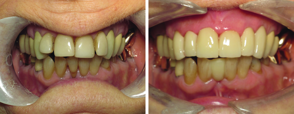 All- porcelain crowns to replace old, stained veneers (and straighten the teeth at the same time).