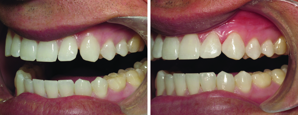 Closing spaces of lateral incisors with composite. No "novocaine" necessary.