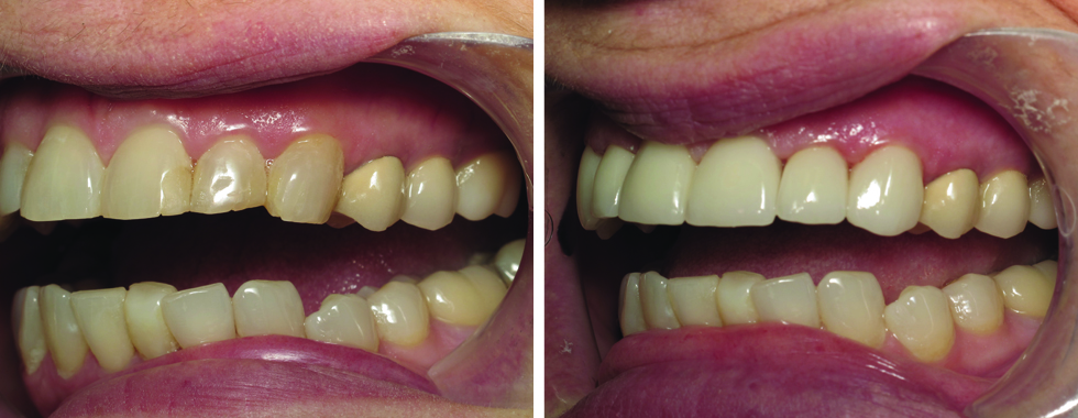 6 all-porcelain crowns to rejuvenate smile