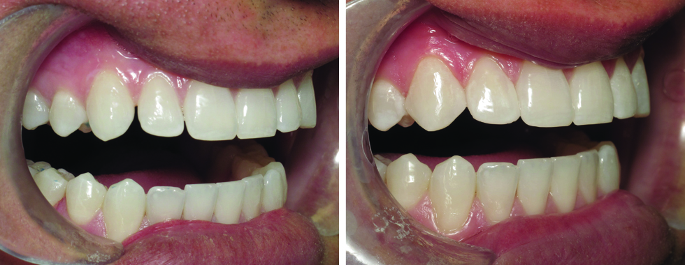 Closing spaces of lateral incisors with composite. No "novocaine" necessary.
