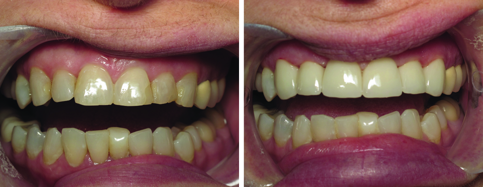 6 all-porcelain crowns to rejuvenate smile