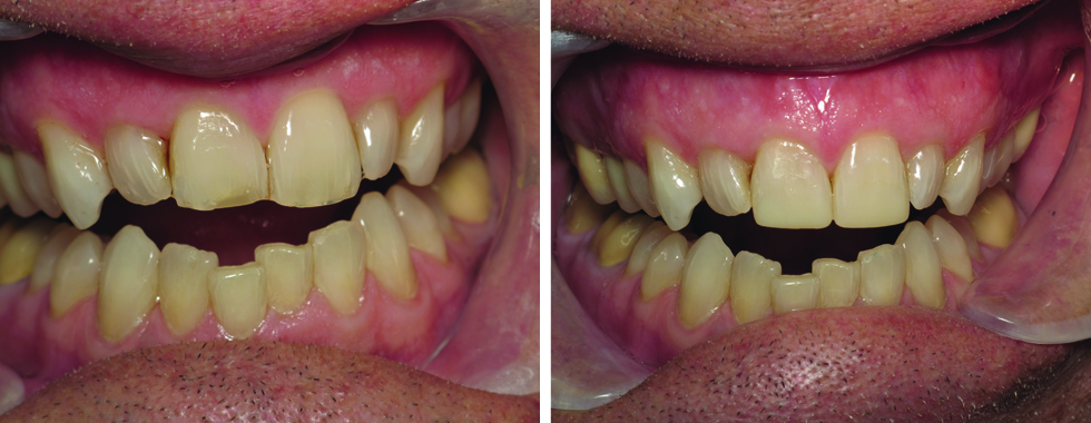 Composite repairs of worn central incisors