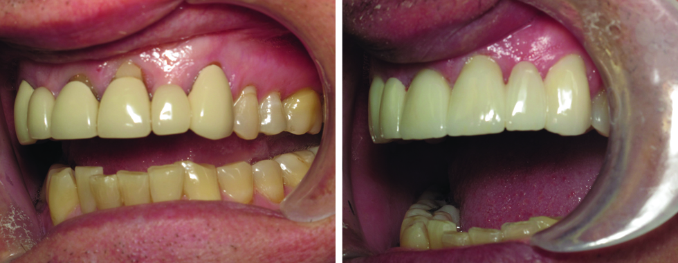 All-porcelain bridgework to replace very old bridges.