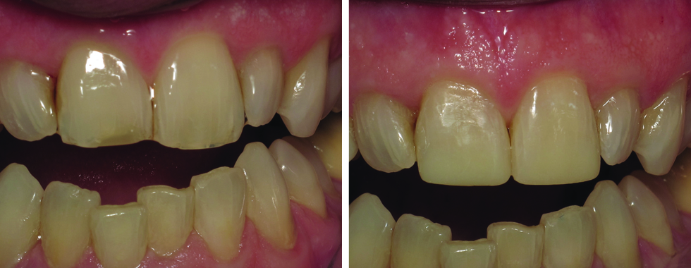 Composite repairs of worn central incisors