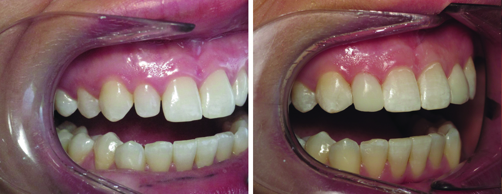 Cosmetic bonding to reshape smaller teeth