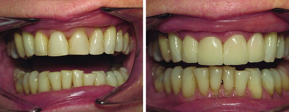 All porcelain crowns