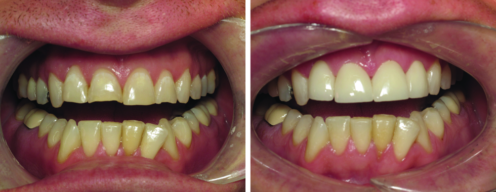 4 all-porcelain crowns to repair fractured incisors.