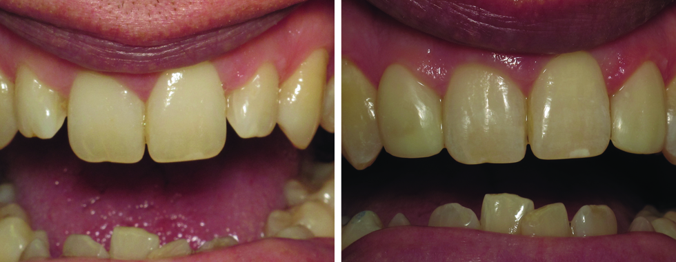 Making small,short lateral incisors look more esthetic. Composite bonding.