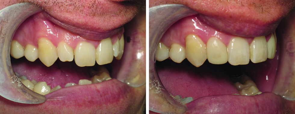 Making small,short lateral incisors look more esthetic. Composite bonding.