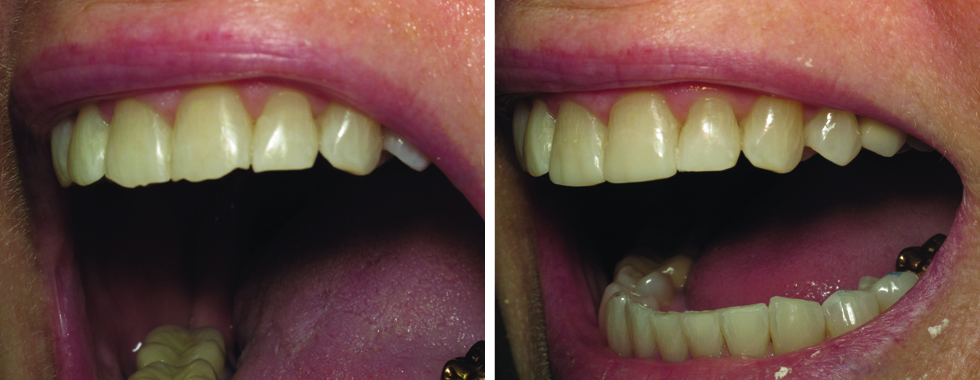 Repair of fractured incisal edges with composite.
