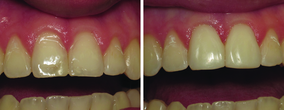 A single composite veneer to make lateral incisor "blend in" better with adjacent teeth.