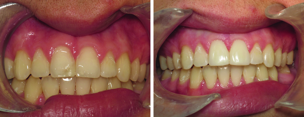 Full composite veneers on the two defective central incisors. One appointment.