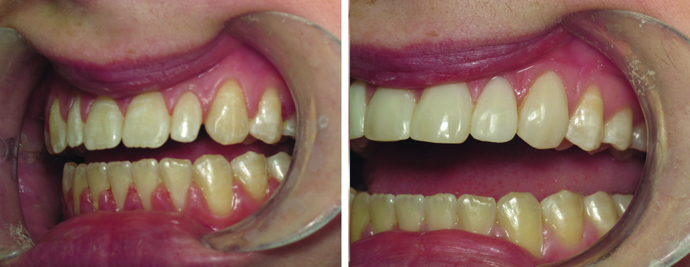 6 composite veneers to improve the color and the shape of the teeth after orthodontics had been done.