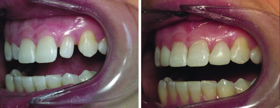 Cosmetic bonding to reshape smaller teeth