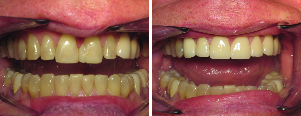 Porcelain crowns to replace discolored, aged teeth