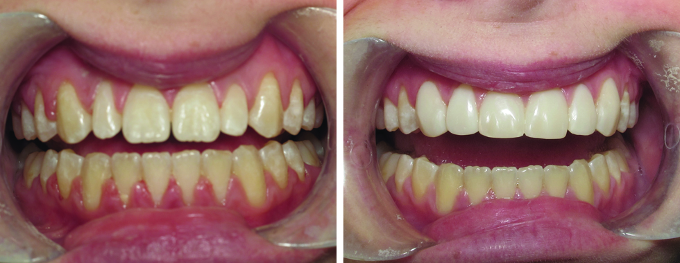 4 composite veneers to replace older, stained veneers. One appointment.