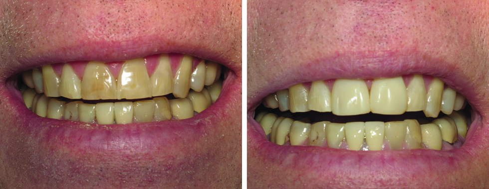 Composite veneers on 2 central incisors to cover worn and severely stained teeth.