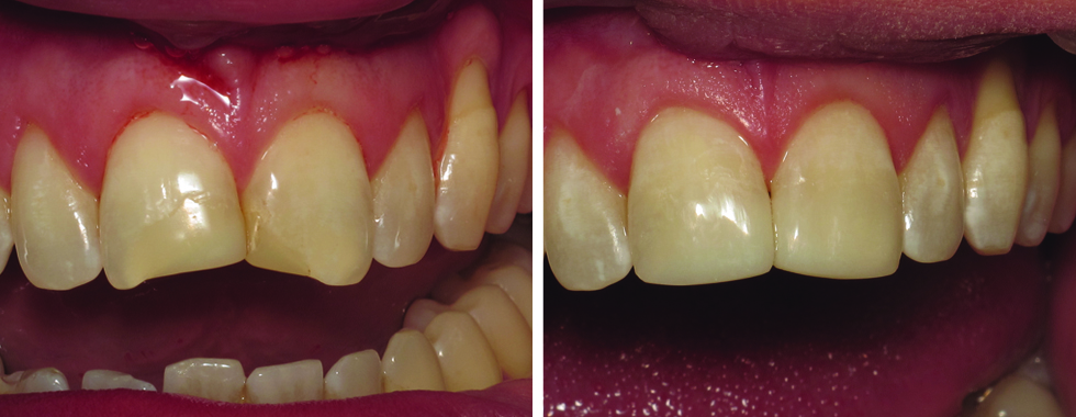Composite repair of severely worn and fractured central incisors.