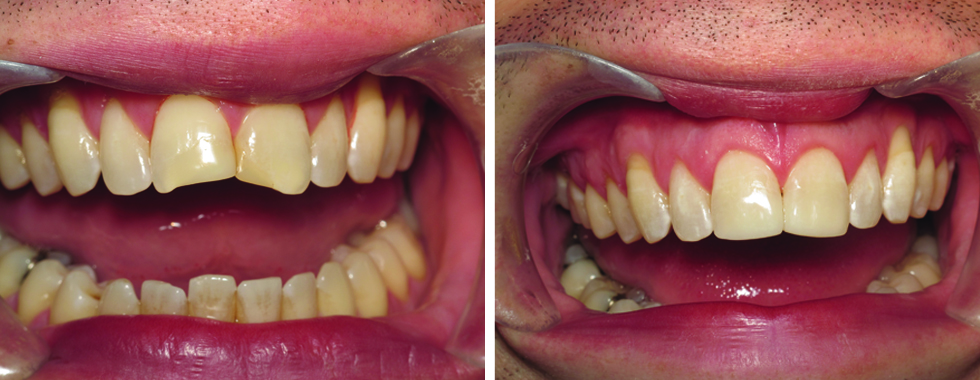 Composite repair of severely worn and fractured central incisors.