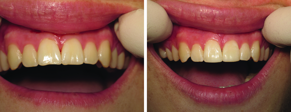 Composite repair of discolored and worn central incisors. (NOT full veneers).