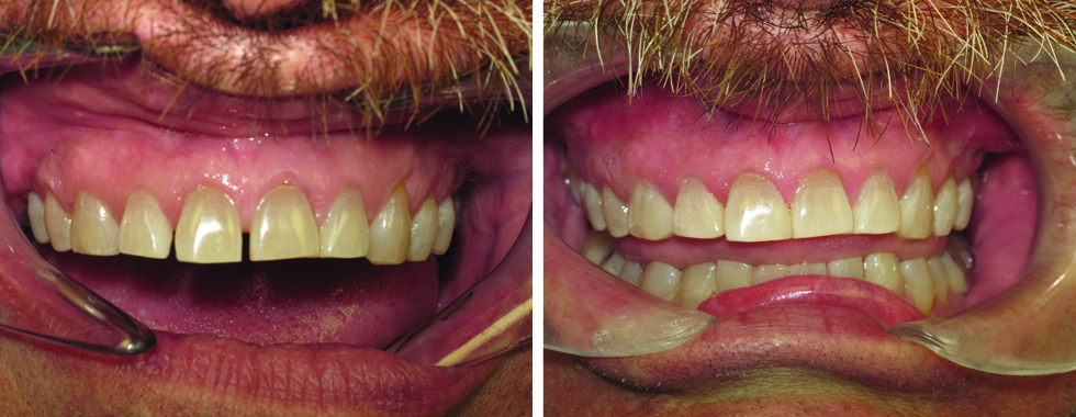 Composite bonding to close spaces on anterior teeth. Very non-invasive. No anesthetic required