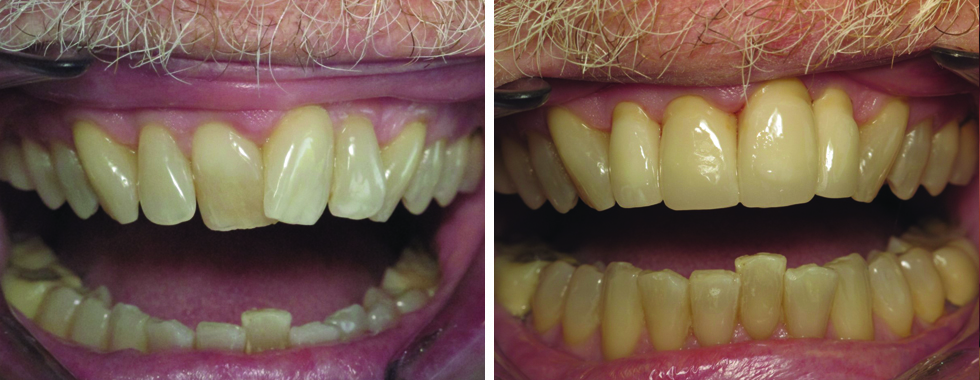 All porcelain crowns to straighten teeth